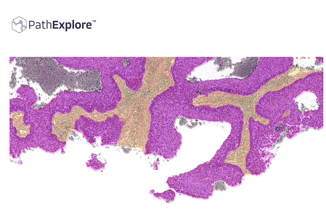 PathAI Expands PathExplore Reach to 14 Cancer Types, Fueling Precision Oncology